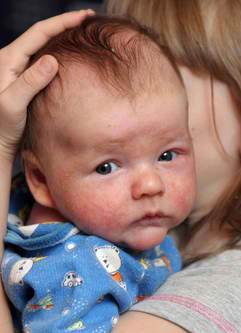 baby-eczema