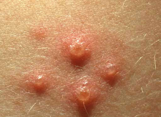 chicken-pox-pictures