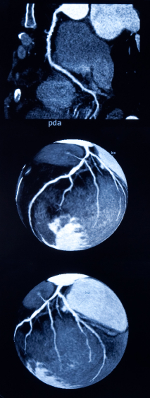 Ангиография фото