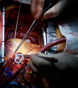 Эмболизация фото