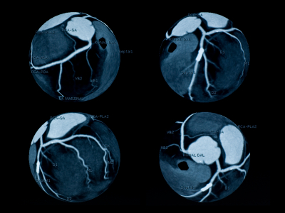 Коронарной ангиографии фото