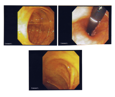Ректороманоскопия фото