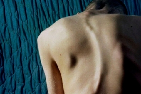 Бескровное лечение сколиоза