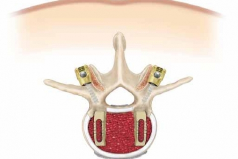 Ультразвук подберет форму полимерного имплантата