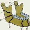 Малоинвазивная хирургия в лечении переломов нижней челюсти