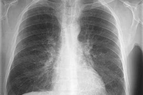 Хронический бронхит - предрак? Ученые нашли ответ