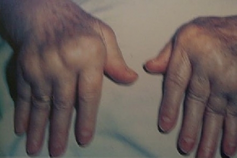 Новый препарат для лечения системных заболеваний соединительной ткани