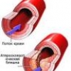 Эффективная профилактика атеросклероза