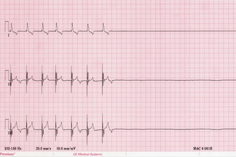 Белок, вызывающий внезапную смерть