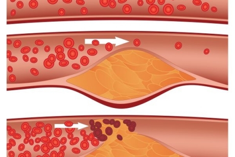 Стволовые клетки, запускающие процесс атеросклероза