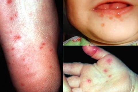 Эпидемия во Вьетнаме