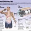 Таблетки-камеры нового поколения выявят болезни желудочно-кишечного тракта