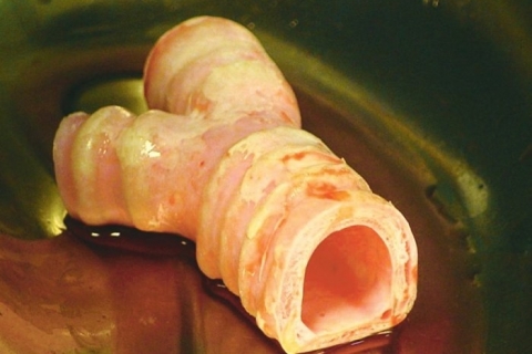 Трансплантация искусственной трахеи выполнена!