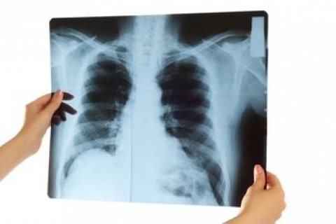 Наночастицы могут вызвать рак легких