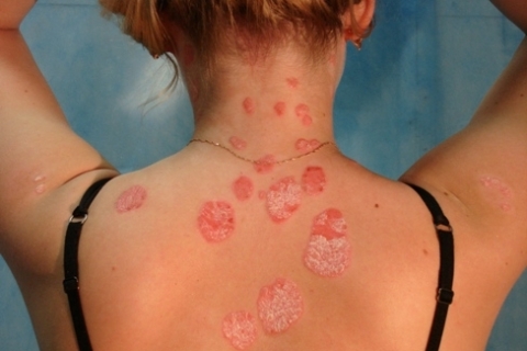 Ген псориаза