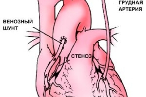 Новый подход к шунтированию сосудов основан на использовании стволовых клеток