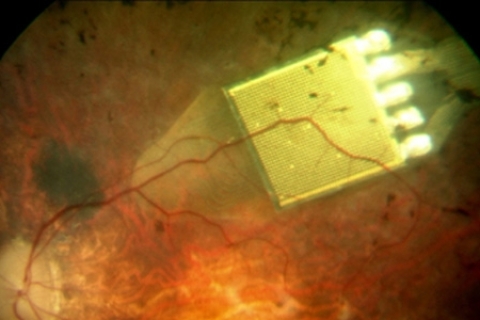 Инновационный прототип искусственной сетчатки