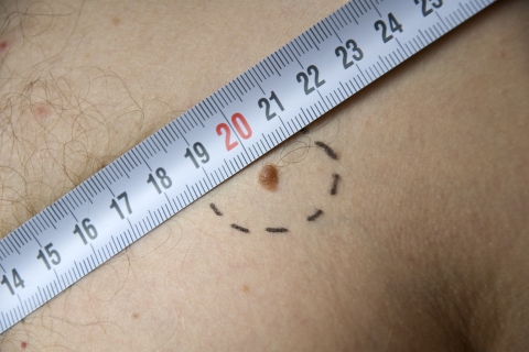 Прием обезболивающих препаратов снижает частоту опухолевых заболеваний