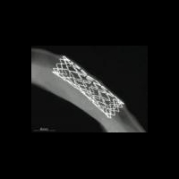 Сосудистый стент самоликвидируется в организме пациента