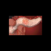 Лапароскопическая резекция головки поджелудочной железы