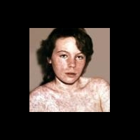 Вспышка кори в Санкт-Петербурге. Москва готовится к внеплановой вакцинации