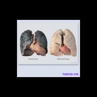 Новый метод лечения хронической обструктивной болезни легких