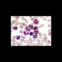 Испанский метод в диагностике болезни Альцгеймера