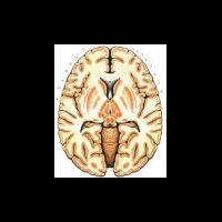 Ученые выявили причину наследственного заболевания головного мозга