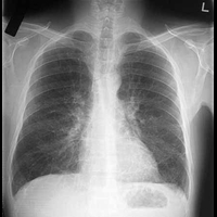 Хронический бронхит - предрак? Ученые нашли ответ