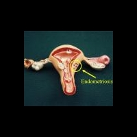 Генетическая мутация может привести к эндометриозу и раку яичников