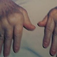 Новый препарат для лечения системных заболеваний соединительной ткани