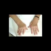 Новая тактика в лечении ревматоидного артрита