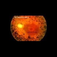 Консервативное нанолечение возрастной дистрофии сетчатки