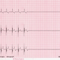 Белок, вызывающий внезапную смерть