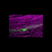 Генная терапия открывает новые возможности в лечении рассеянного склероза