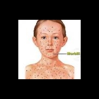 Корь завоевывает страны Восточной Европы