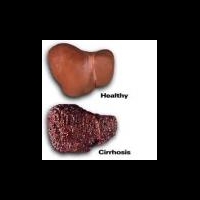 Вакцина против вирусного гепатита С входит в клинические испытания III фазы