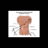 Удаление конкрементов желчного пузыря без холецистэктомии