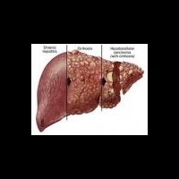 Вирусный гепатит С можно вылечить: российские ученые показали эффективный препарат