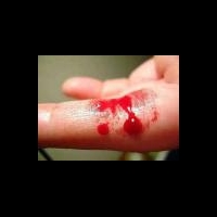 Генная инженерия победит гемофилию В