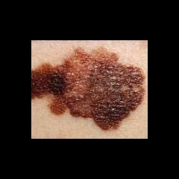 Мультивитаминные комплексы, содержащие витамин А, влияют на риск возникновения меланомы