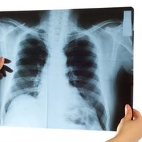 Наночастицы могут вызвать рак легких