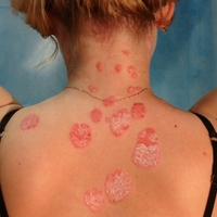 Ген псориаза