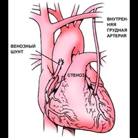 Новый подход к шунтированию сосудов основан на использовании стволовых клеток