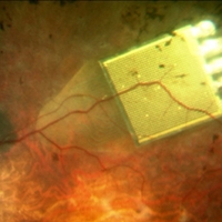 Инновационный прототип искусственной сетчатки