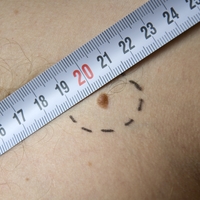 Прием обезболивающих препаратов снижает частоту опухолевых заболеваний